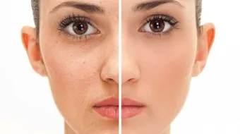 كيفية التخلص من حب الشباب وآثاره