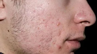 كيف تتخلص من حب الشباب في أسرع وقت