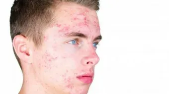 كيفية التخلص من حب الشباب نهائياً