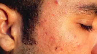 كيفية التخلص من ندبات حب الشباب