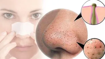 طريقة التخلص من الرؤوس السوداء