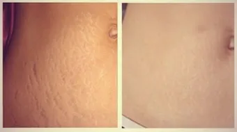 كيفية التخلص من تشققات البطن بعد الولادة