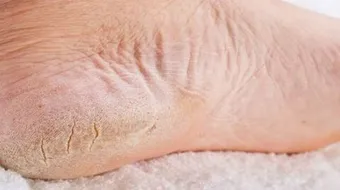 كيف تتخلص من تشققات القدمين