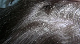 كيف تتخلص من قشرة الرأس