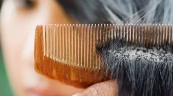 كيف يتم التخلص من قشرة الرأس