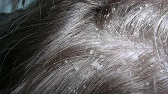 كيفية التخلص من القشرة في الرأس نهائياً