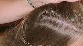 كيف يتم التخلص من القمل