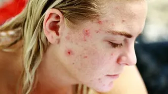 كيف تتخلص من البثور