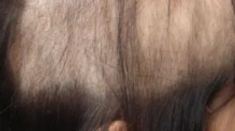 كيف تتخلص من عادة نتف الشعر