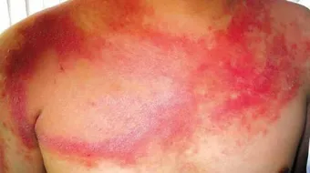 كيف يكون سرطان الجلد