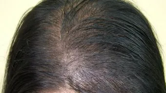 طريقة إخفاء فراغات الشعر