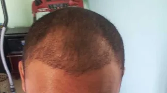 طريقة تكثيف الشعر من الأمام