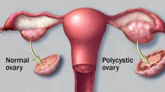 كيفية معرفة تكيس المبايض