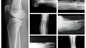 كيفية الوقاية من هشاشة العظام