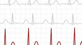 طريقة قراءة تخطيط القلب