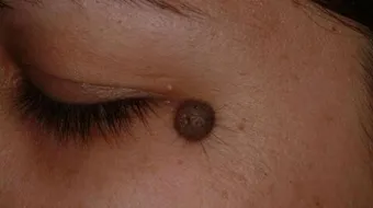 كيفية إزالة حبة الخال