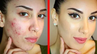 طريقة إزالة حب الشباب للبشرة الدهنية