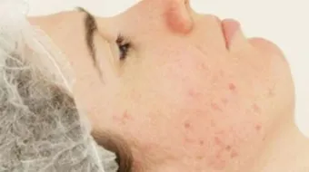 كيف أزيل حب الشباب من الوجه