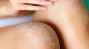 كيف أزيل سواد الركب