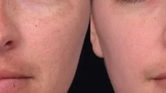 كيف أزيل الكلف نهائياً