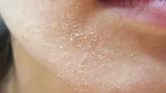 كيف أزيل قشرة الوجه