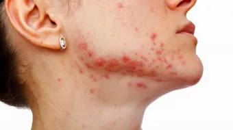 طريقة إزالة حبوب الوجه