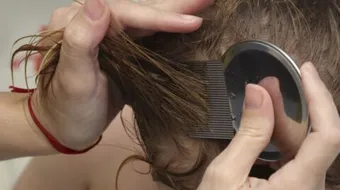 كيفية إزالة القمل والصيبان