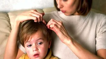 طريقة إزالة القمل من الرأس