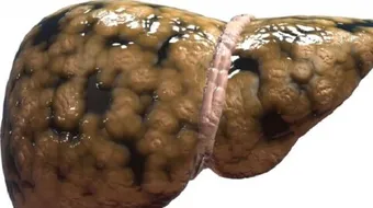 كيفية إزالة دهون الكبد