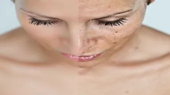 كيفية إزالة الكلف