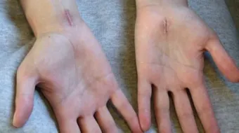 كيفية إزالة علامات الجروح