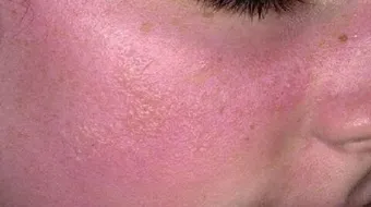 كيفية إزالة حروق الشمس