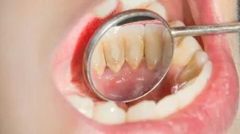 كيف أزيل الجير من الأسنان