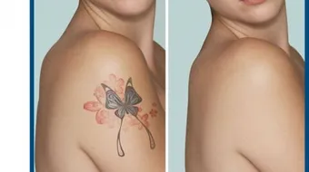 كيفية إزالة الوشم