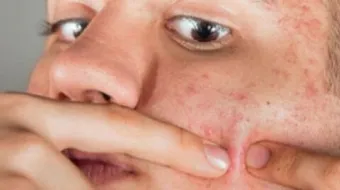 كيف أبعد آثار حب الشباب