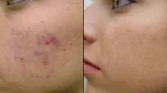 كيف تزيل آثار الحبوب من الوجه