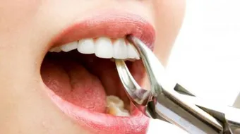 كيف يتم خلع الضرس