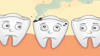 كيف أزيل تسوس الأسنان