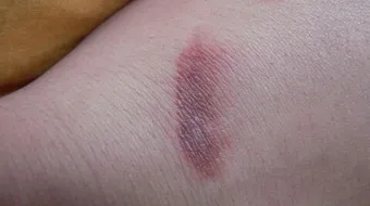 كيفية إزالة آثار الحروق القديمة