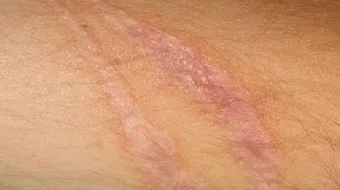 كيف أزيل آثار الجروح القديمة