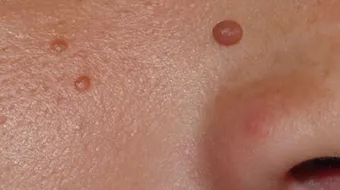 كيفية إزالة الثآليل من الوجه