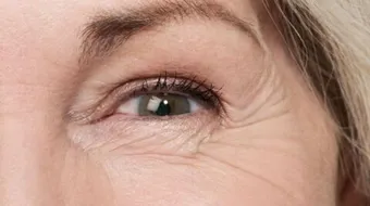 كيفية إزالة التجاعيد تحت العين