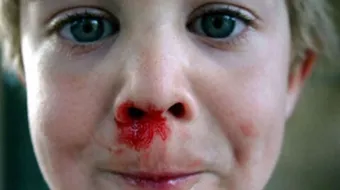 طريقة وقف نزيف الأنف