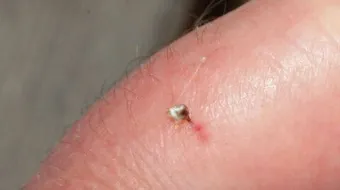 كيف تعالج قرصة النحل