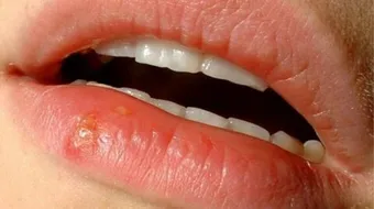 كيف تعالج حبة السخونة