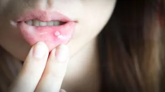 كيفية علاج قرحة الفم