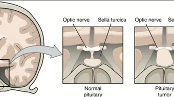 كيفية علاج ورم الغدة النخامية