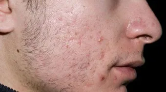 كيف يمكن معالجة حب الشباب