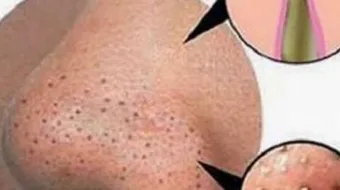 كيفية علاج حب الشباب والرؤوس السوداء