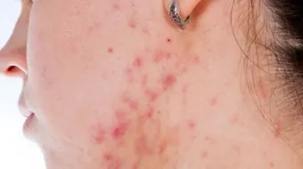 كيفية علاج حب الشباب للبشرة الدهنية